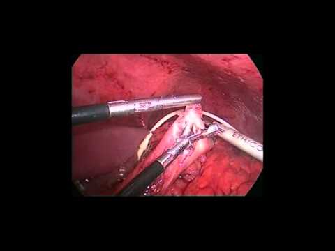 Laparoscopic Removal Of Eroded Adjustable Gastric Band