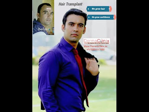 Advanced Hair transplantation by FUE at DELHI,INDIA with unbelievable results