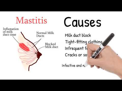 Mastitis - Breast pain during lactation or pregnancy. Mastitis symptoms and treatment.