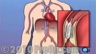 Heart Health Stent Implantation Coronary Surgery PreOp® Patient Education Feature