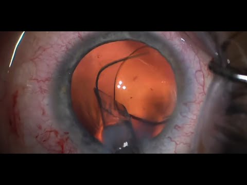 Revolutionizing Vision: Light Adjustable Lens Selection Insights