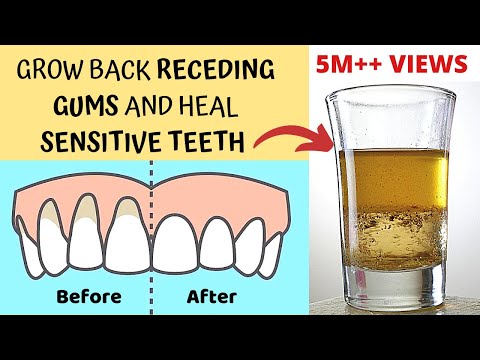 Heal Receding Gums and Grow Back | Treat Sensitive Teeth and Reverse Receding Gums | Gingivitis