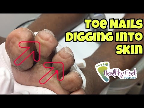 Nails Curling Into Toes - Nail Trimming for Diabetic. Ingrown Nails at the Ends of the Toe. Video