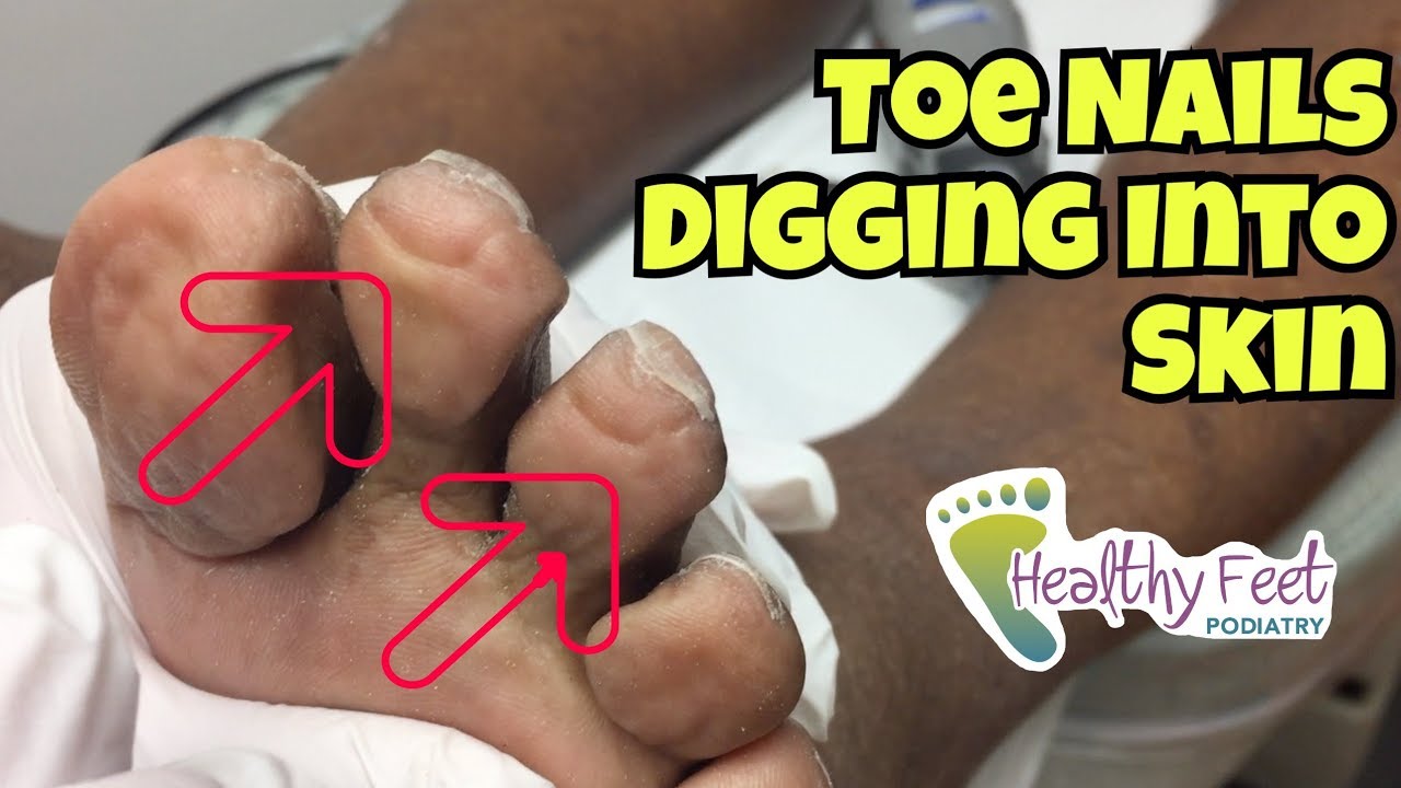 <h1 class=title>Nails Curling Into Toes - Nail Trimming for Diabetic. Ingrown Nails at the Ends of the Toe.</h1>
