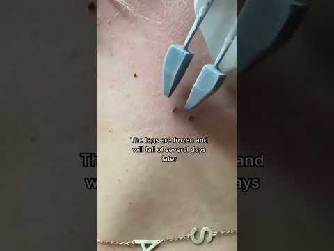 How to get rid of skin tags! #dermeeacts #doctoreacts #skintags