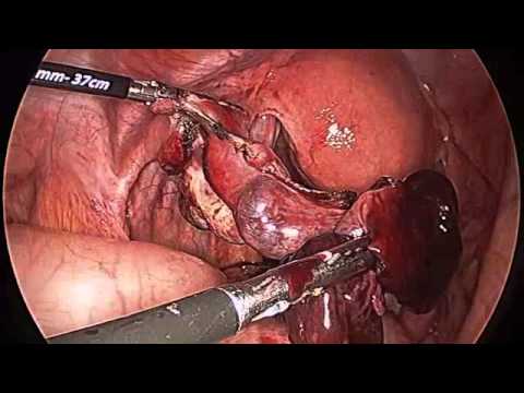 Laparoskopowa salpingektomia z powodu pęknietej ciąży ektopowej