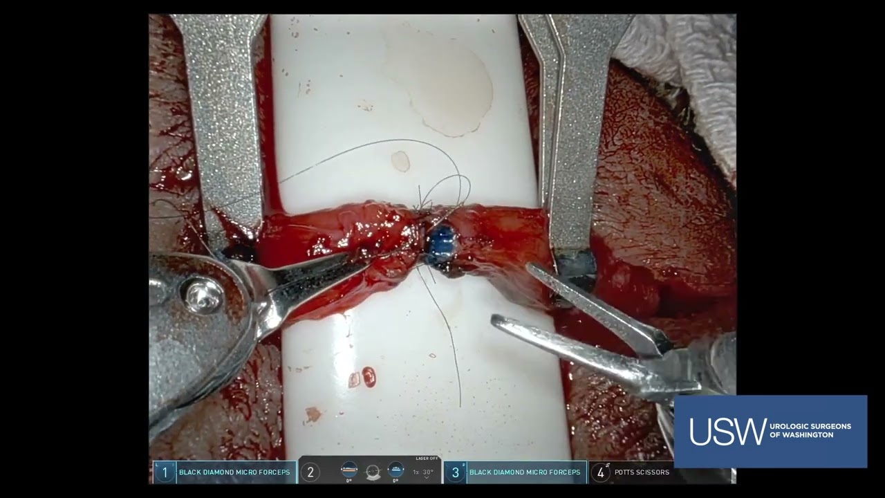 Robotic Vasovasostomy | Vasectomy Reversal (Actual Surgery)