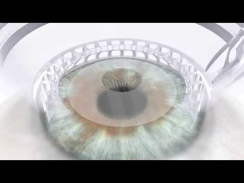 Animation SMILE Pro VisuMax 800 Zeiss