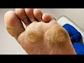 MONSTER FOOT CALLUS REMOVAL Part 2 Very Satisfying