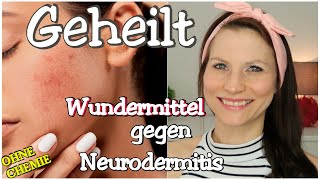 Neurodermitis | Ich wurde komplett geheilt | Wundermittel