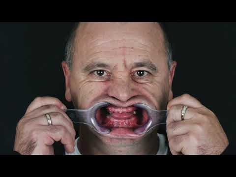All on six upper and lower - jaw Soft tissue management - ADI concept