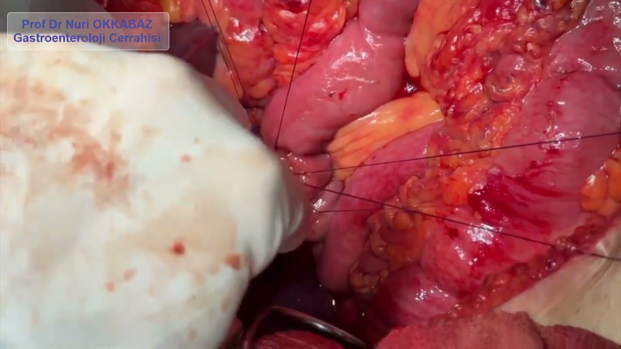 Safra yolu anastomozu (uç yan hepatikojeunostomi)