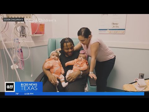 Former conjoined twins both go home