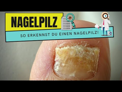 Narywajet der Nagel auf dem Bein die Behandlung Gribok des Nagels bis zu kutikuly