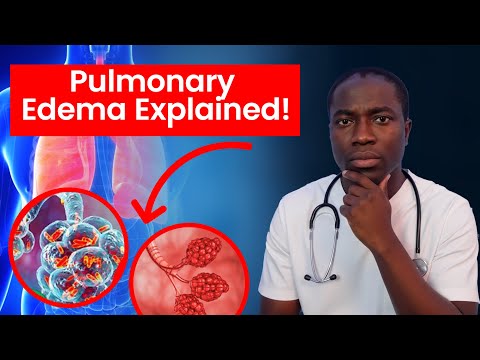 Top Doctor Shares FAST Pulmonary Edema Treatment Secrets