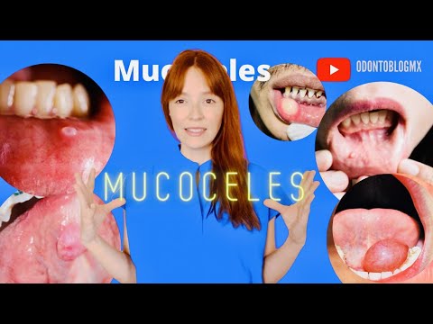 Mucoceles