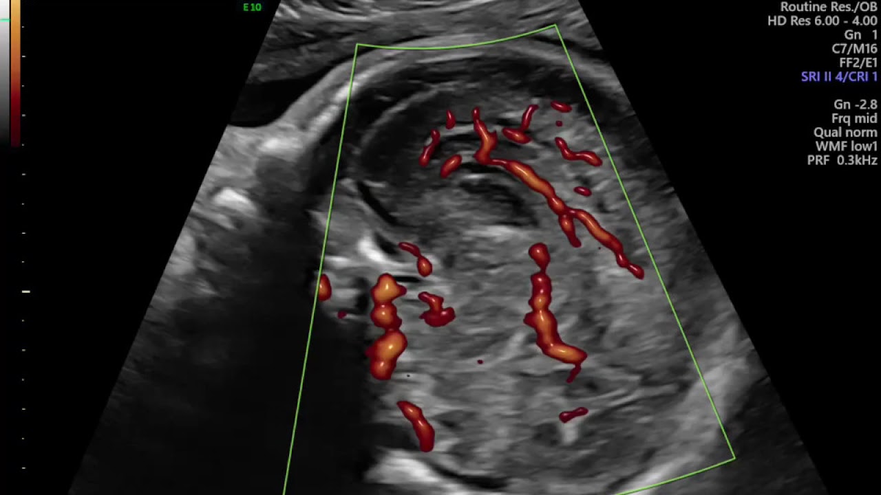 AVALIAÇÃO DE CORPO CALOSO EM ULTRASSON MORFOLOGICO