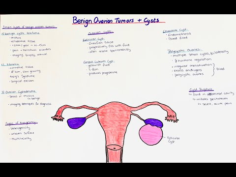Benign Ovarian Tumors + Ovarian Cysts - histology + clinics