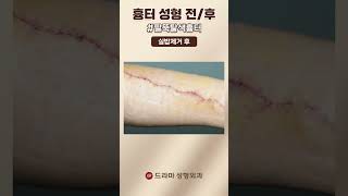 P-샷 성형 시술