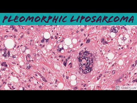 Pleomorphic Liposarcoma: 5-Minute Pathology Pearls