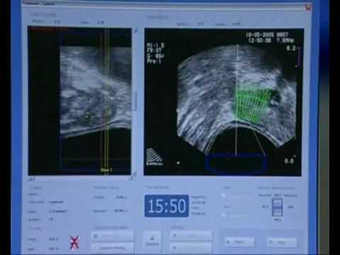Seltsame Empfindungen in der Prostata Ob es steht Prostatahyperplasie