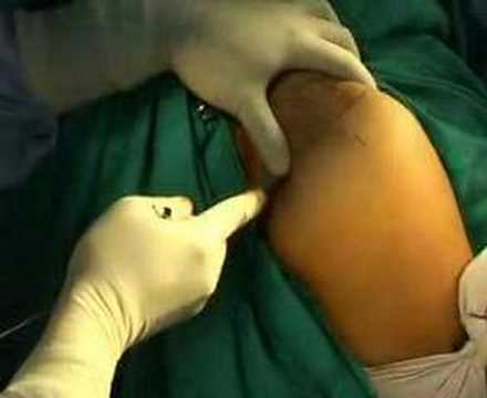 Arthroscopy Of The Arm And Posterior Portal Placement 