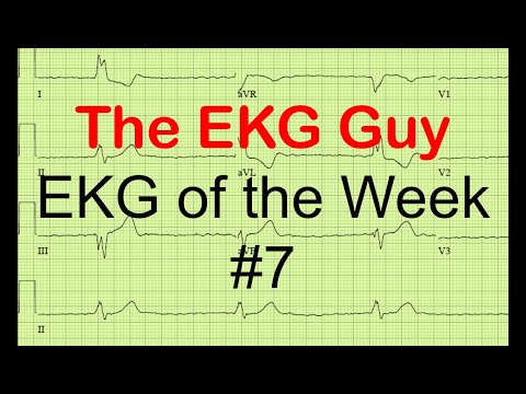 EKG/ECG of the Week #7 | The EKG Guy - www.ekg.md