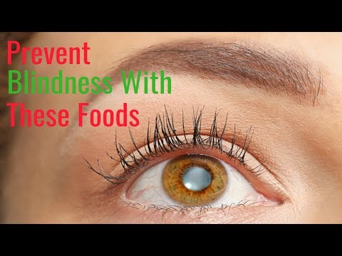 How to Prevent Cataracts Naturally With Foods