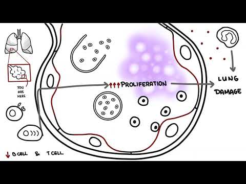 Pneumocystis jirovecii - Pneumocystis-Pneumonie