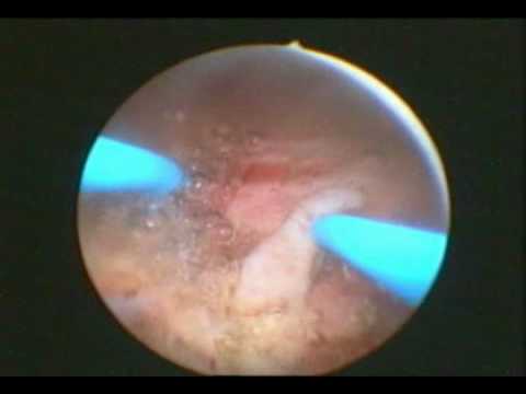 Orgasmo della prostata Adenoma della prostata e vermi