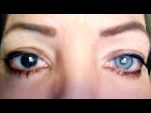 BrightOcular - Behind the Implant: An Interview with a Patient