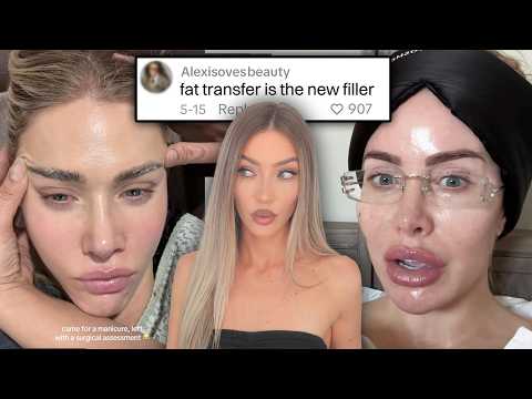 fat transfer is the new fillers