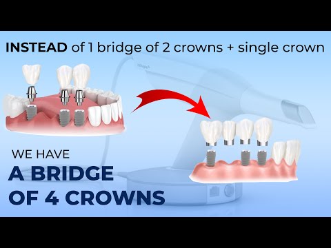 Instead of one bridge of two crowns and a single crown we have a bridge of four crowns