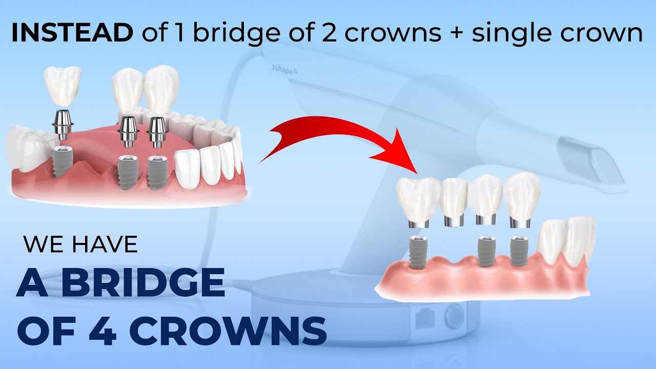 Instead of one bridge of two crowns and a single crown we have a bridge of four crowns