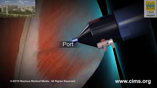 Laparoscopic Ventral Incisional Hernia Repair – CIMS Hospital