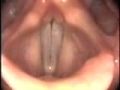 Stroboscopy Rigid Normal Female Vocal Cords Mid Range