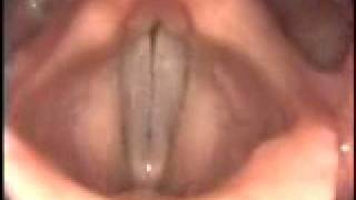 Stroboscopy Rigid Normal female vocal cords mid range Mp4 3GP & Mp3