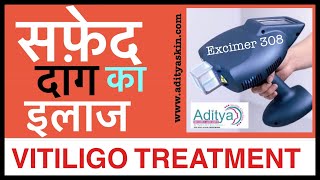 VITILIGO TREATMENT | सफ़ेद दाग का इलाज EXCIMER 308 मशीन से कैसे होता है  DR PRIYANK SEN in HINDI