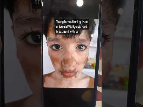 Incredible Vitiligo Recovery Journey: Young Boy Sees Pigmentation in Just 4 Months!