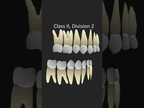 Angles Classification of Malocclusion #shorts #dentistry #orthodontics