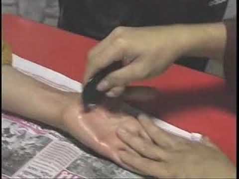การแพทย์ทางเลือกจีน (2) เรื่อง การขูดมือรักษาโรค ช่วงที่ 2