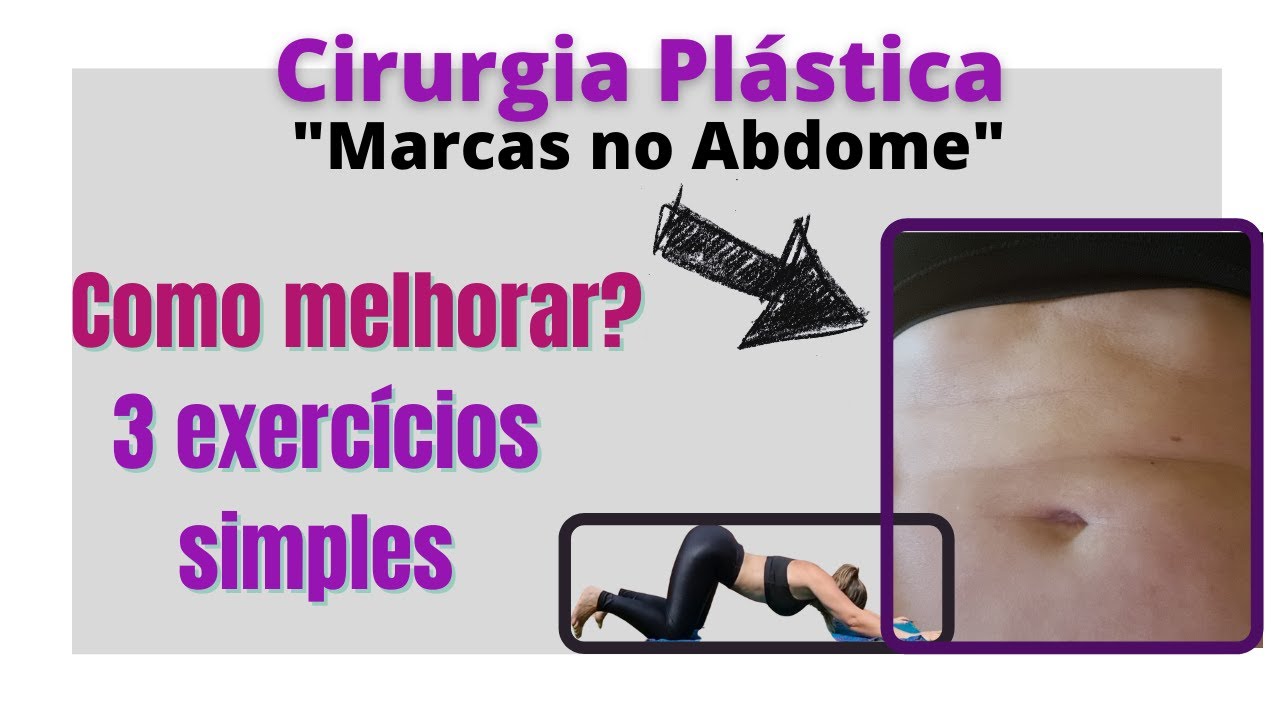 Dobras no abdome pós lipoaspiração e abdominoplastia: como melhorar