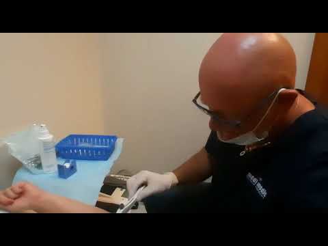 Zabieg wszczepienia implantu antykoncepcyjnego.