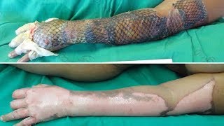 Brazilian doctors are using fish skin to treat burn victims – here's why.
