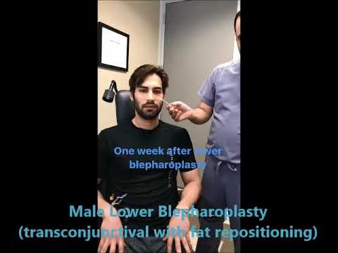 Male Lower Blepharoplasty Surgery Male Lower Blepharoplasty Surgery