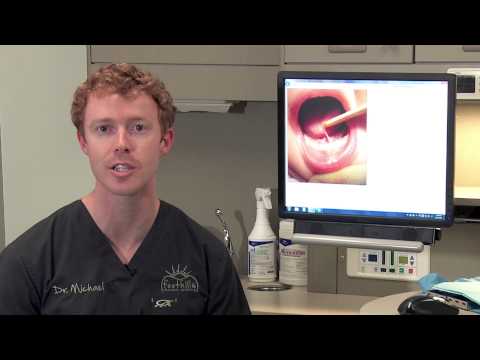 Tongue tie and the Frenulectomy procedure