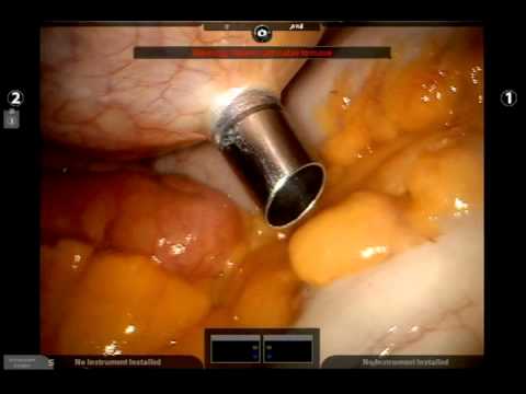 Port Placement for Robot-Assisted Prostatectomy