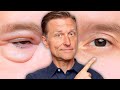THIS Is How You Get Rid Of Puffy Eyes FOR GOOD