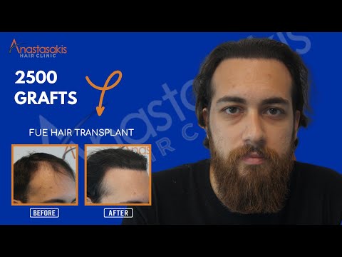 Αποτελέσμα Μεταμόσχευσης Μαλλιών με 2500 FUs – Repair Case