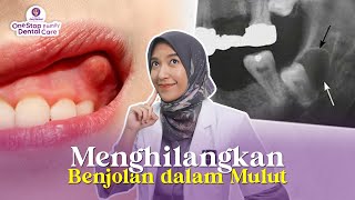 Download lagu IS THERE A WAY TO REMOVE A LUMBAR ON THE TOOTH? DENTAL CYST mp3 Download lagu IS THERE A WAY TO REMOVE A LUMBAR ON THE TOOTH? DENTAL CYST mp3